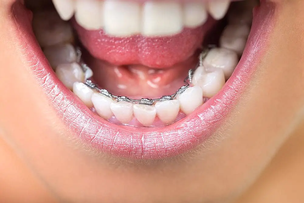 A close-up reveals lingual braces on a person's lower teeth, with metal brackets and wires neatly fitted on the inner side of each tooth in NYC