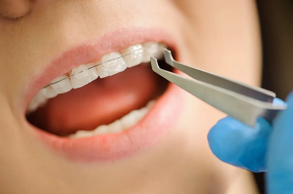 A close-up of an individual with adult braces and lips slightly apart. A gloved hand holds tweezers near the clear aligners, demonstrating precision in orthodontic care in NYC