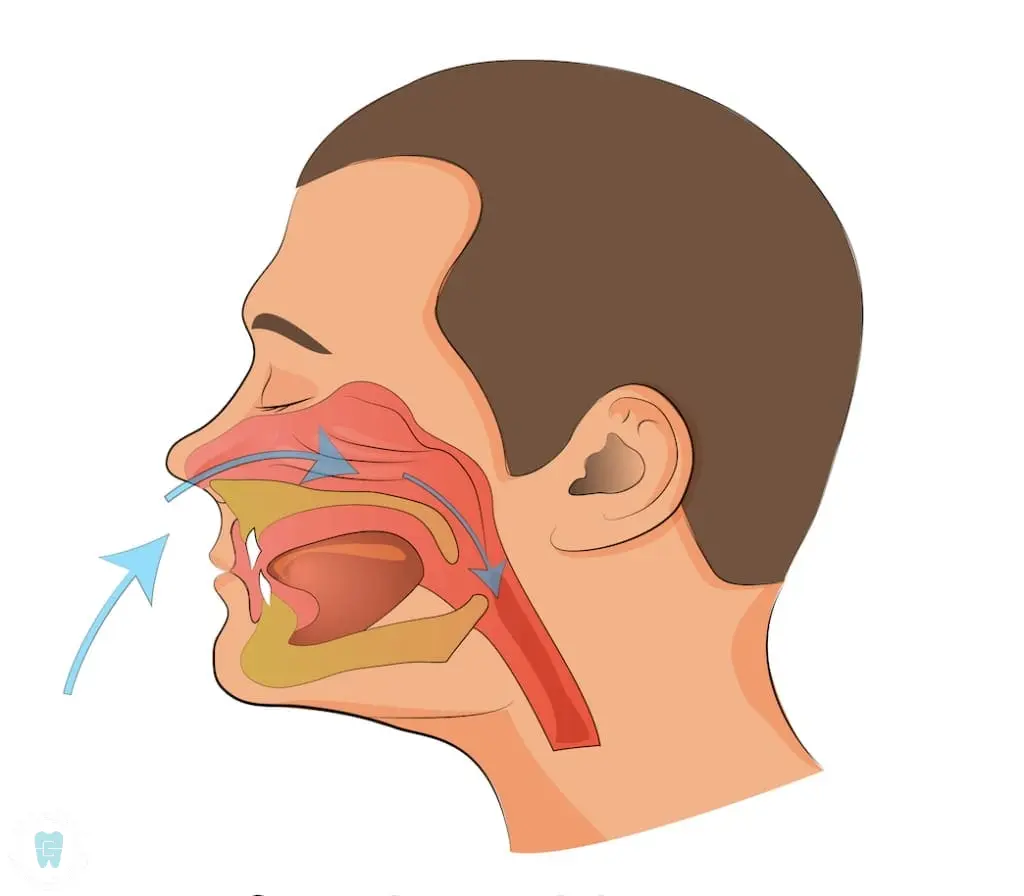 Illustration of a side view of a human head showing the nasal and oral passages, with arrows indicating mouth breathing airflow through these areas for an orthodontist in NYC