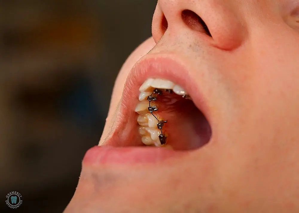 a close up photo of opened mouth showing a set of lingual braces as one of the alternatives to braces in New York, NY