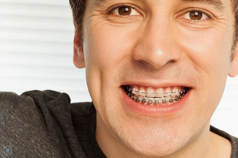 happy young man with metal braces - Overbite vs Underbite in New York, NY