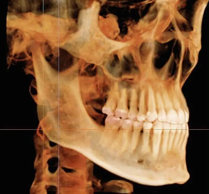 Side profile 3D scan showing teeth, jawbone, and neck at Gramercy Orthodontics in New York, NY with advanced technology.