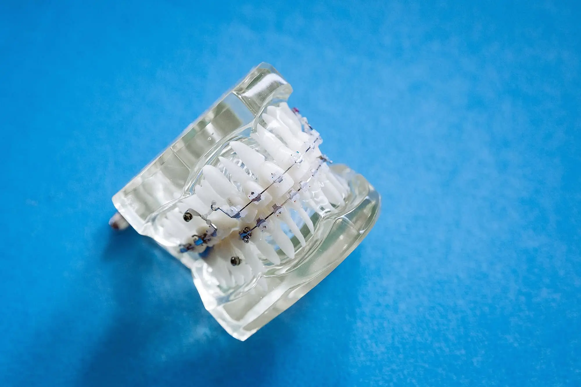 A clear dental model showcasing metal braces on teeth, set against a serene blue background in NYC