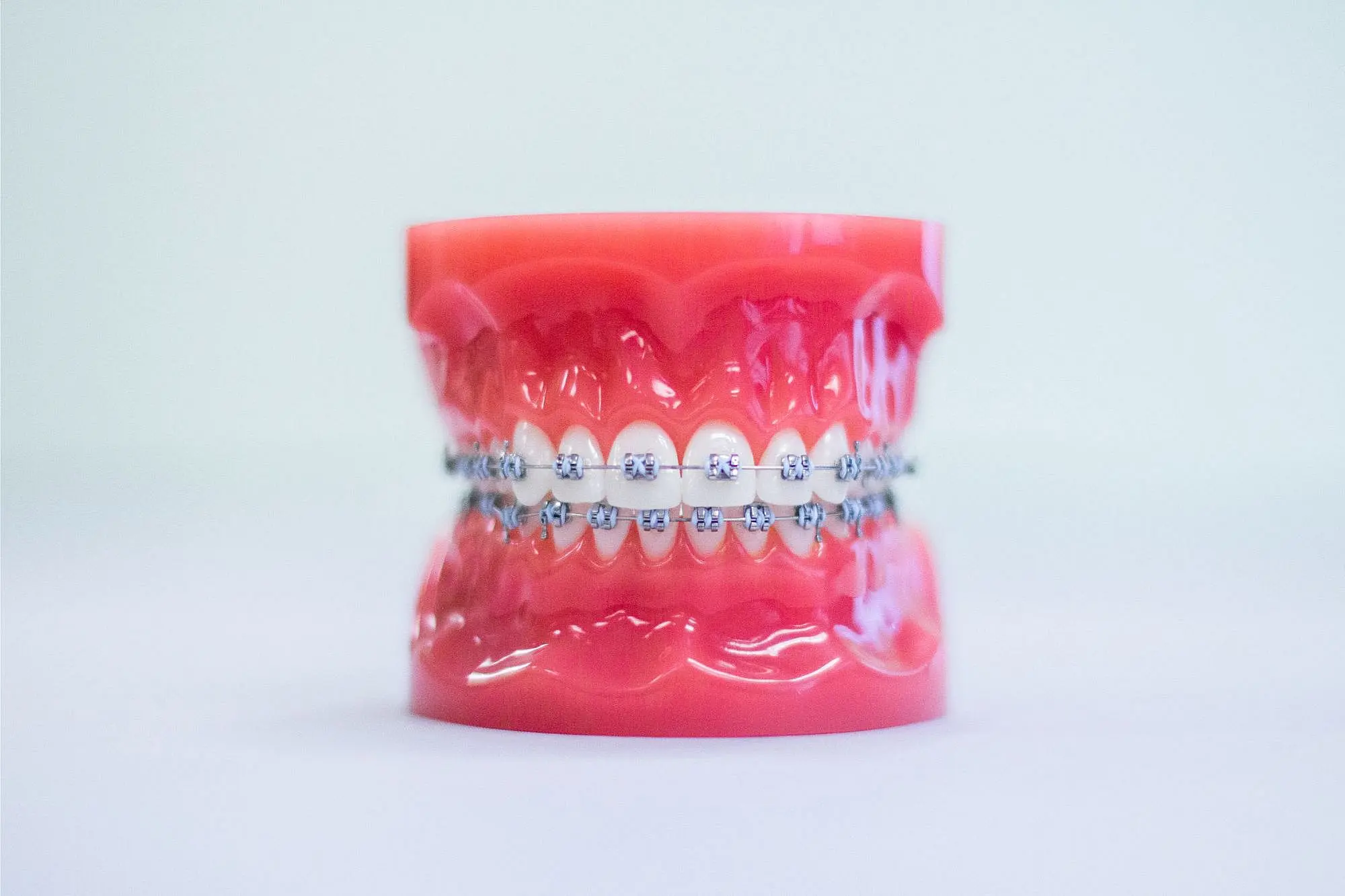A dental model showcases metal braces meticulously fitted on the teeth, presented against a plain backdrop in NYC