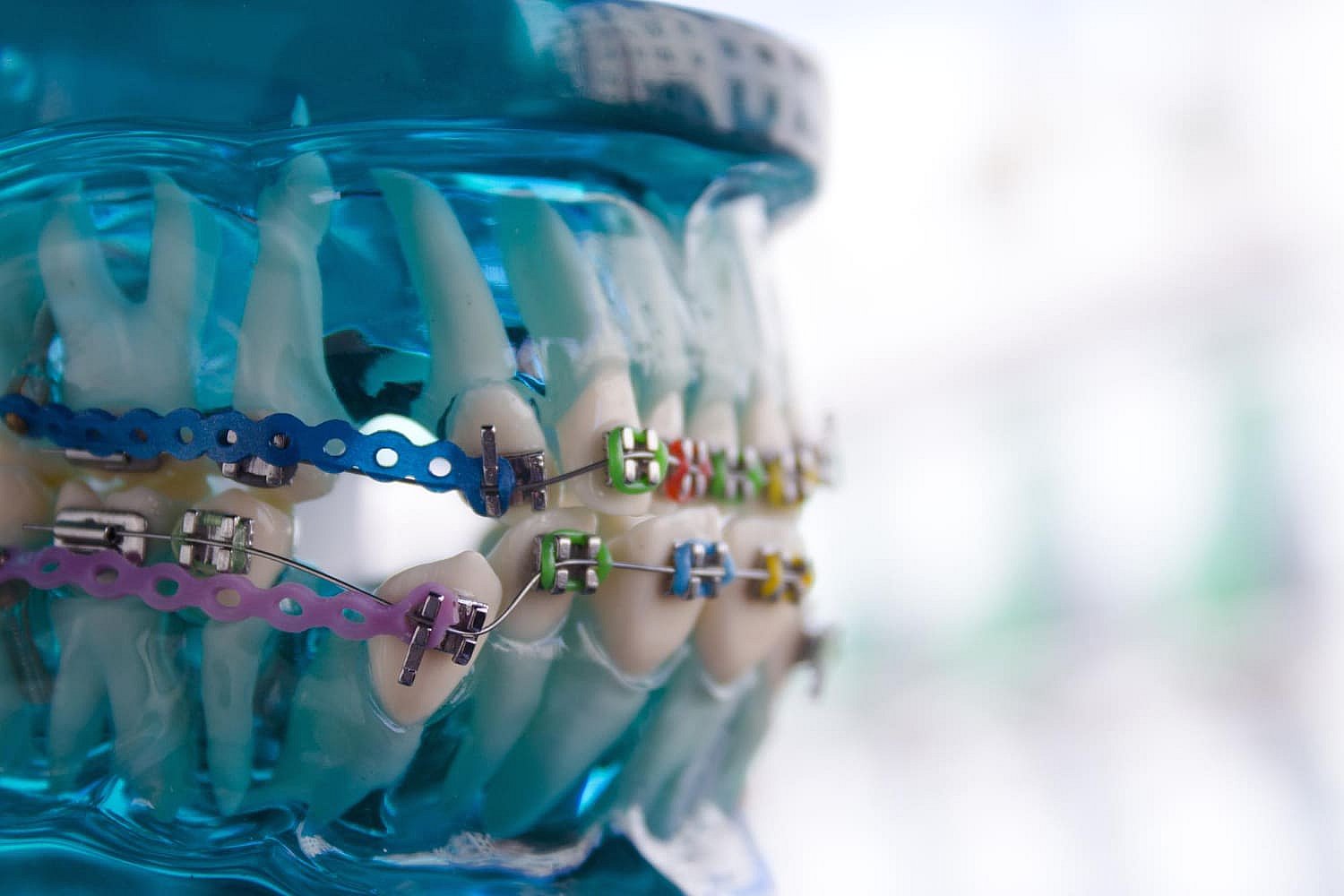 A dental model with vibrant, metal braces on teeth, elegantly displayed on a blue stand in NYC
