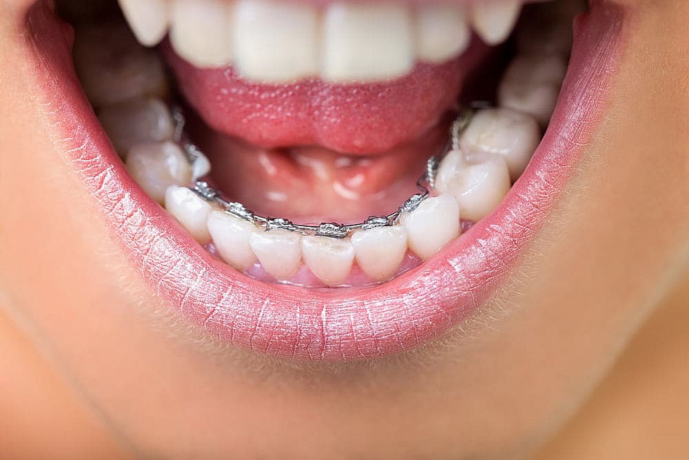 A close-up reveals the glossy sheen of clear lip gloss highlighting the subtle elegance of lingual braces discreetly aligned on the lower teeth in NYC
