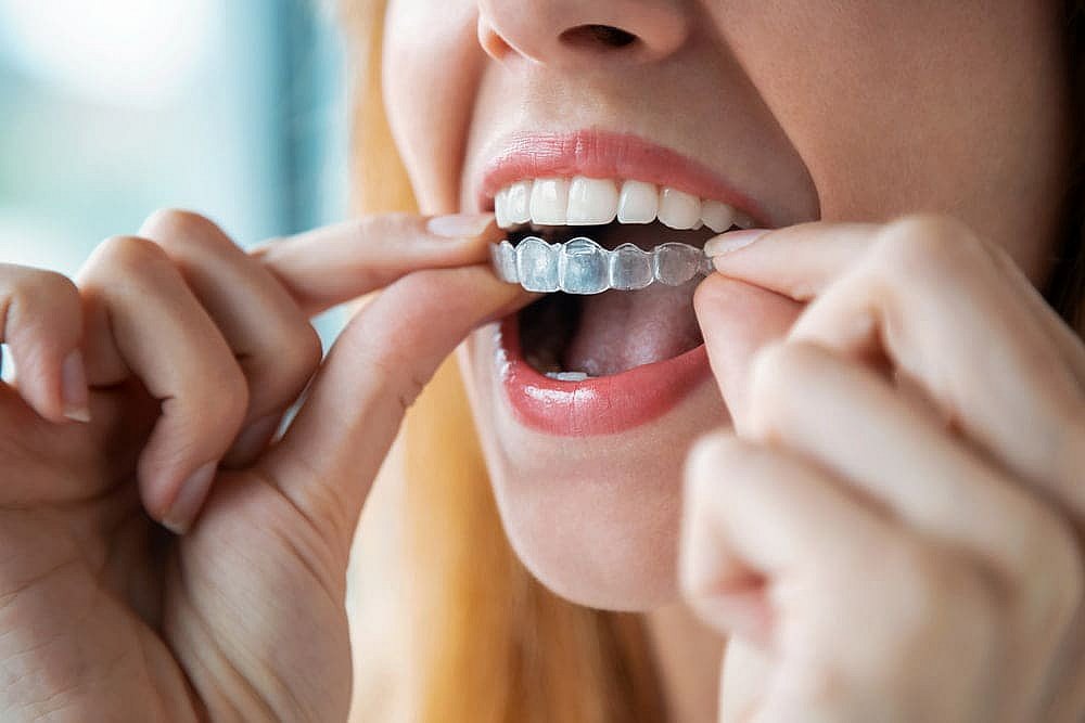 A person is carefully inserting a clear dental aligner, exploring the benefits of Invisalign versus traditional braces for a perfect smile in NYC