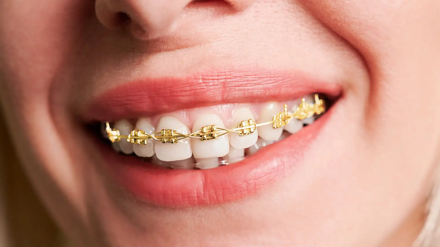 Gold braces treatment at Gramercy Orthodontics