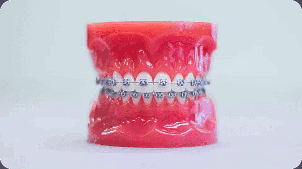 A dental model showcases metal braces meticulously fitted on the teeth, presented against a plain backdrop in NYC